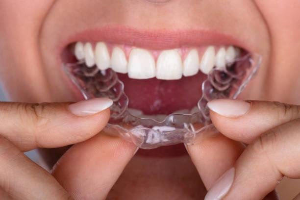 Clear teeth aligners karachi